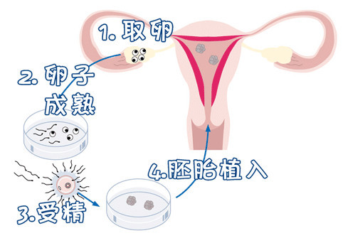 供精试管供卵中介生殖医学中心